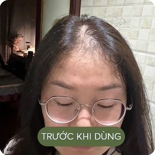 Đường chân tóc trước khi dùng