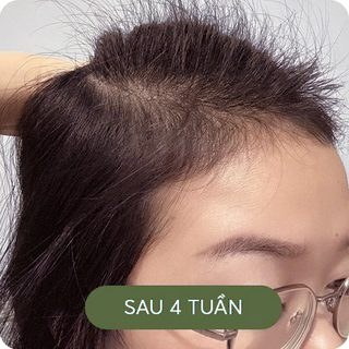 Đường chân tóc sau 4 tuần