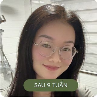 Đường chân tóc sau 9 tuần